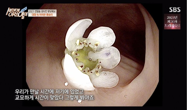 대장내시경하다 발견된거