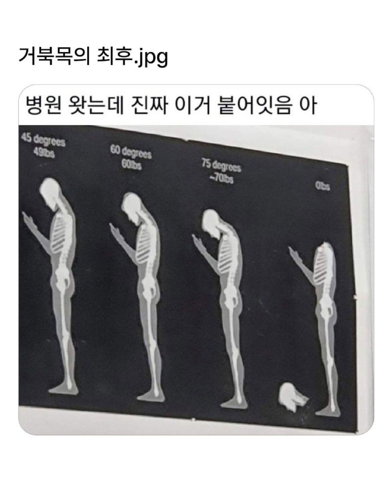 거북목의 최후.JPG