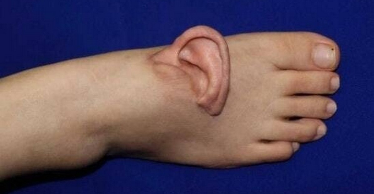 (약혐) 5개월 동안 '발등'에 귀 달고 다닌 여성의 사연