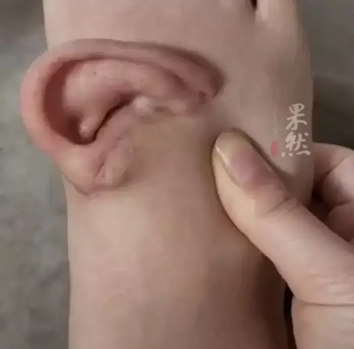 (약혐) 5개월 동안 '발등'에 귀 달고 다닌 여성의 사연