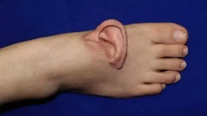 (약혐) 5개월 동안 '발등'에 귀 달고 다닌 여성의 사연