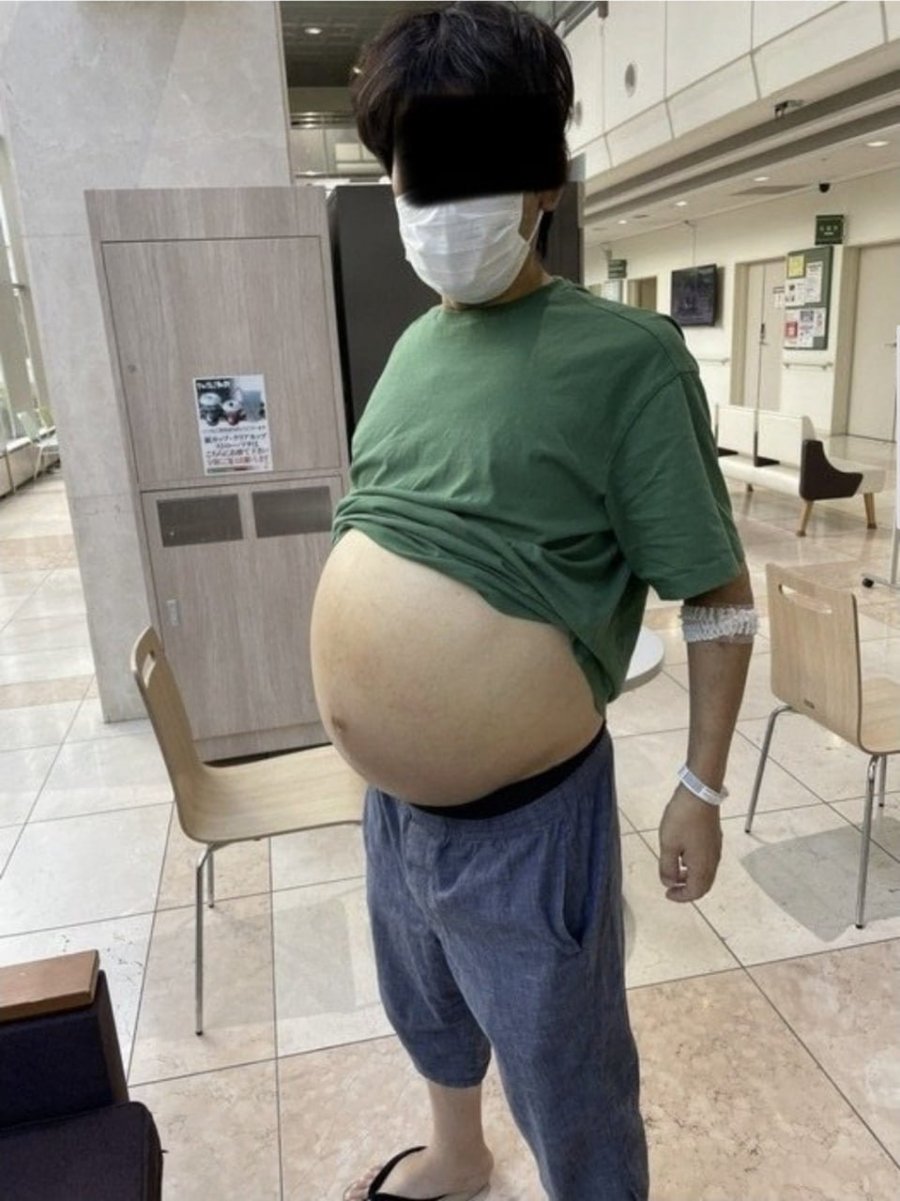 맥주를 10년간 매일 3L씩 마신 일본 남자