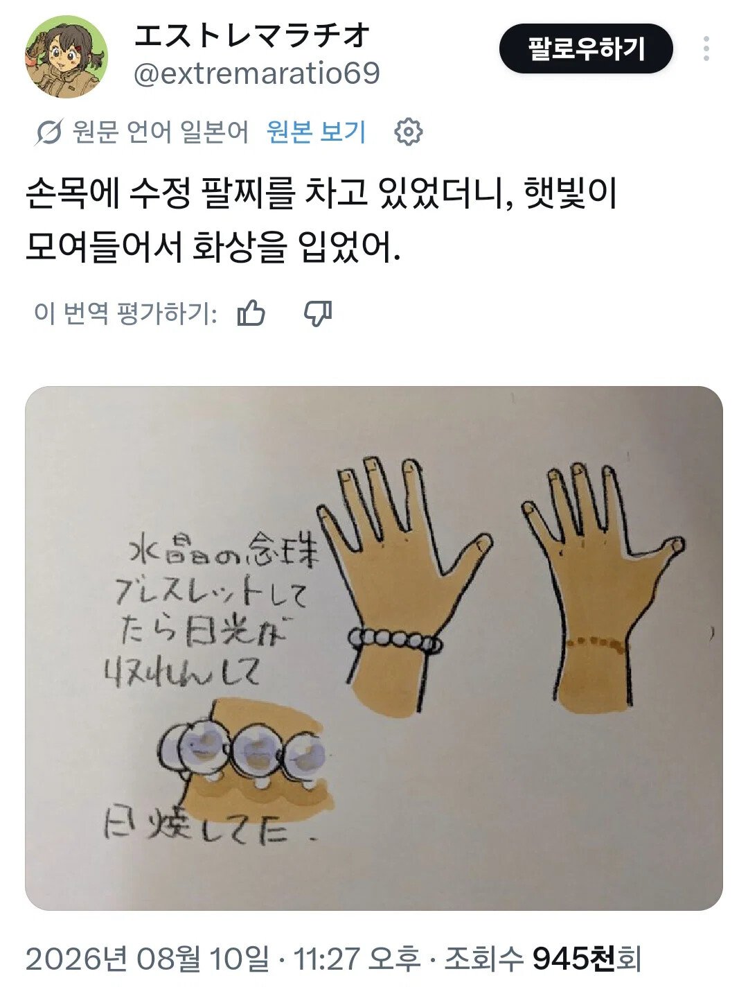 악세사리 때문에 손목에 화상 입음.jpg