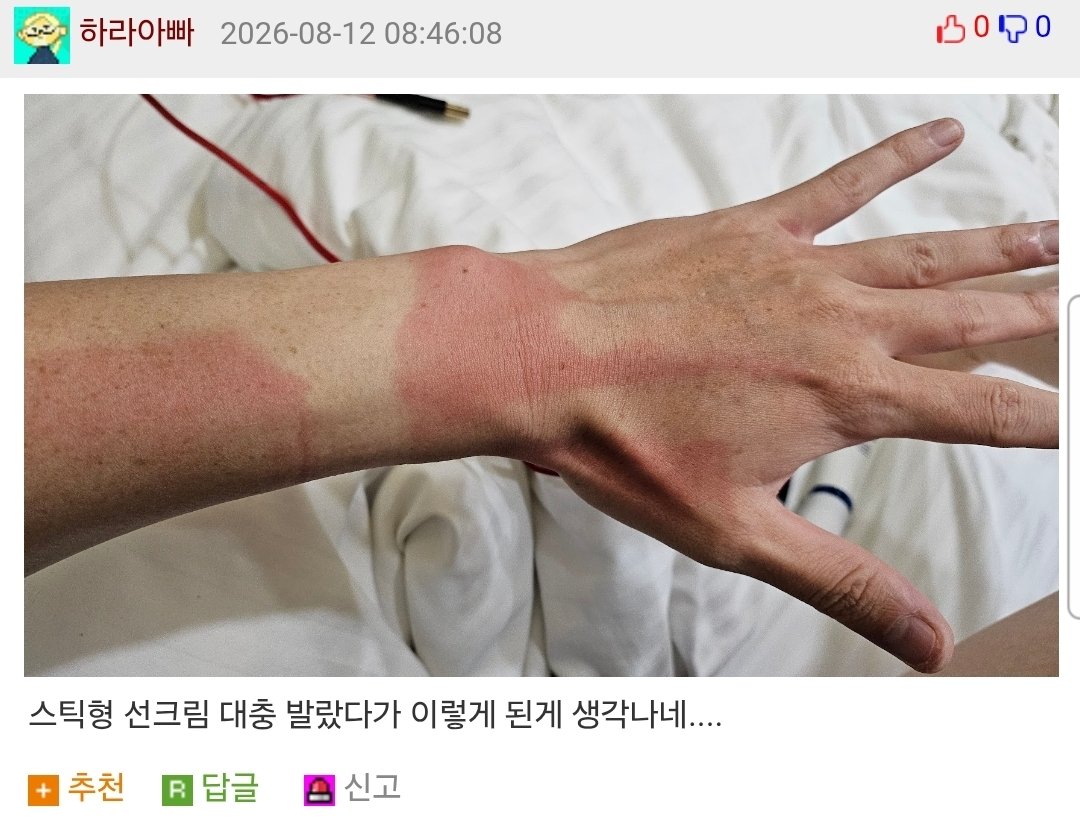 악세사리 때문에 손목에 화상 입음.jpg